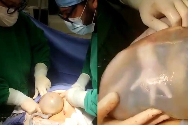 Nascimento raro: Bebê nasce empelicado em cesárea de gêmeos em Santo Ângelo