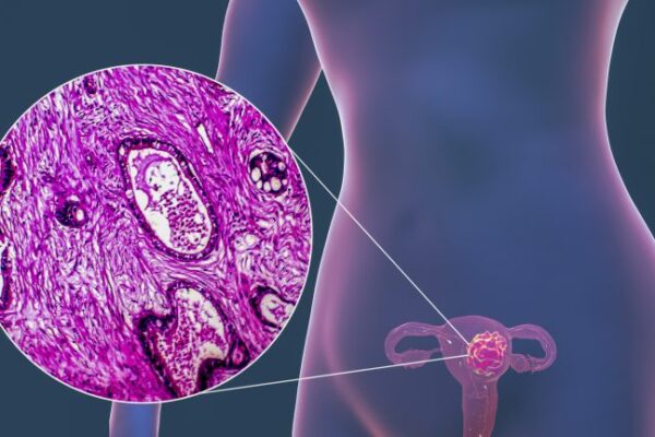 SUS incorpora novo teste para detecção de HPV em mulheres