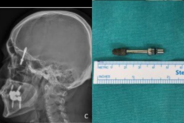 Parafuso de implante dentário fica alojado no cérebro de paciente após erro médico