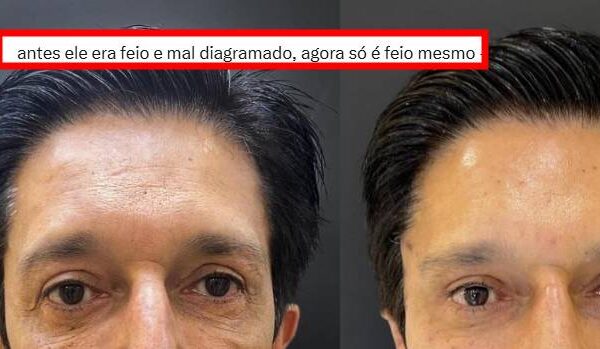 “Agora só é feio”: Prefeito de SP, Ricardo Nunes, comemora reeleição com harmonização facial e internet reage